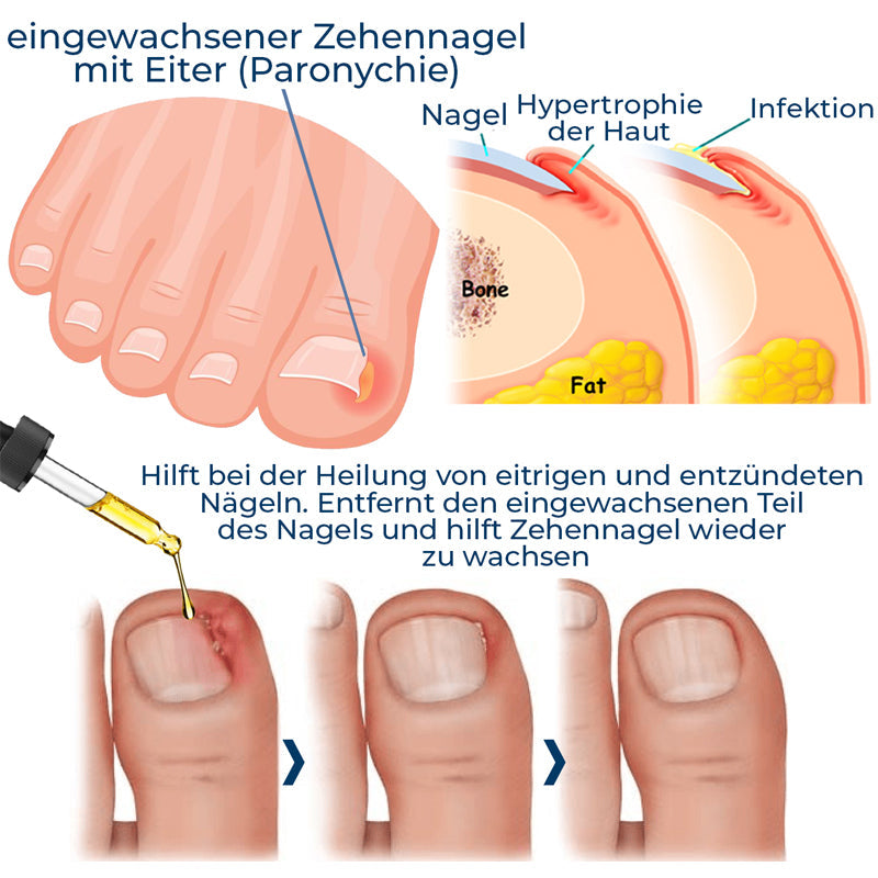 German ToenailPlus™ Anti Paronychia Hilfe Öl